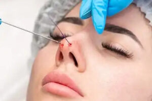 تجميل الأنف الرياض 