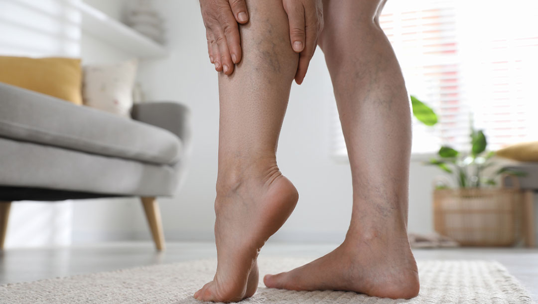 Spider Veins In Manchester