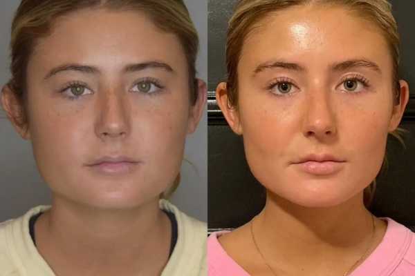 Buccal Fat Removal in Dubai