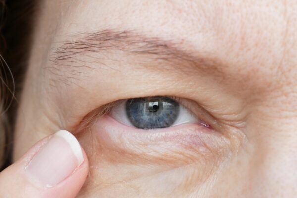 Eyelid Bag Surgery Dubai