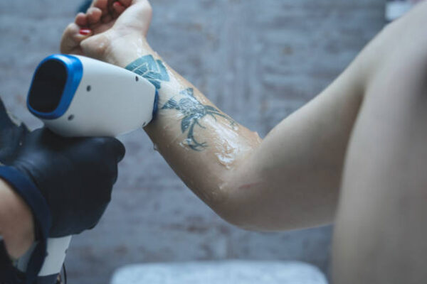 Can Laser Tattoo Removal Remove Color Tattoos