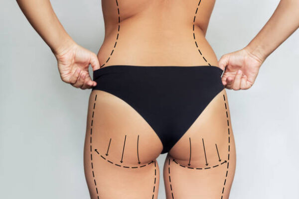 Does Body Jet Liposuction Work Well on Thigh Fat