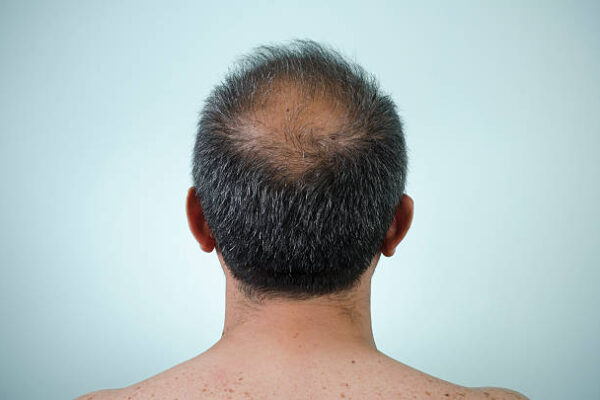 Does Hair Loss Treatment regrow lost hair