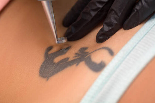 Does Tattoo Removal Work on All Skin Types Safely