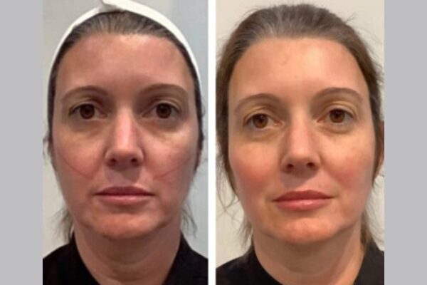 Thread lift Treatment in Dubai Ensuring Safe Sterile Clinical Environment Standards