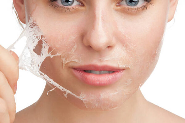 How Can Chemical Peel Boost Your Skin's Natural Glow