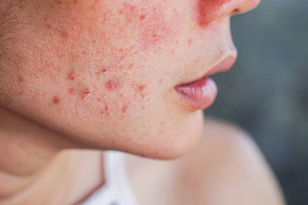 How Does Acne Treatment Support Long Term Skin Health