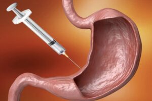 Gastric Botox in Abu Dhabi