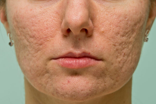 Laser Acne Scar treatment in Abu Dhabi