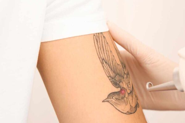 Laser Tattoo Removal in Abu Dhabi