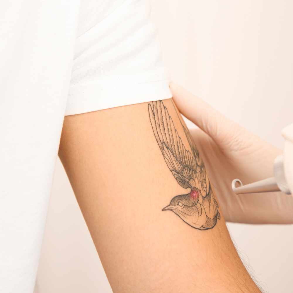 Laser Tattoo Removal in Abu Dhabi