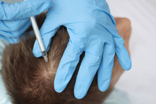 How Long Do Stem Cell Hair Transplant Results Last