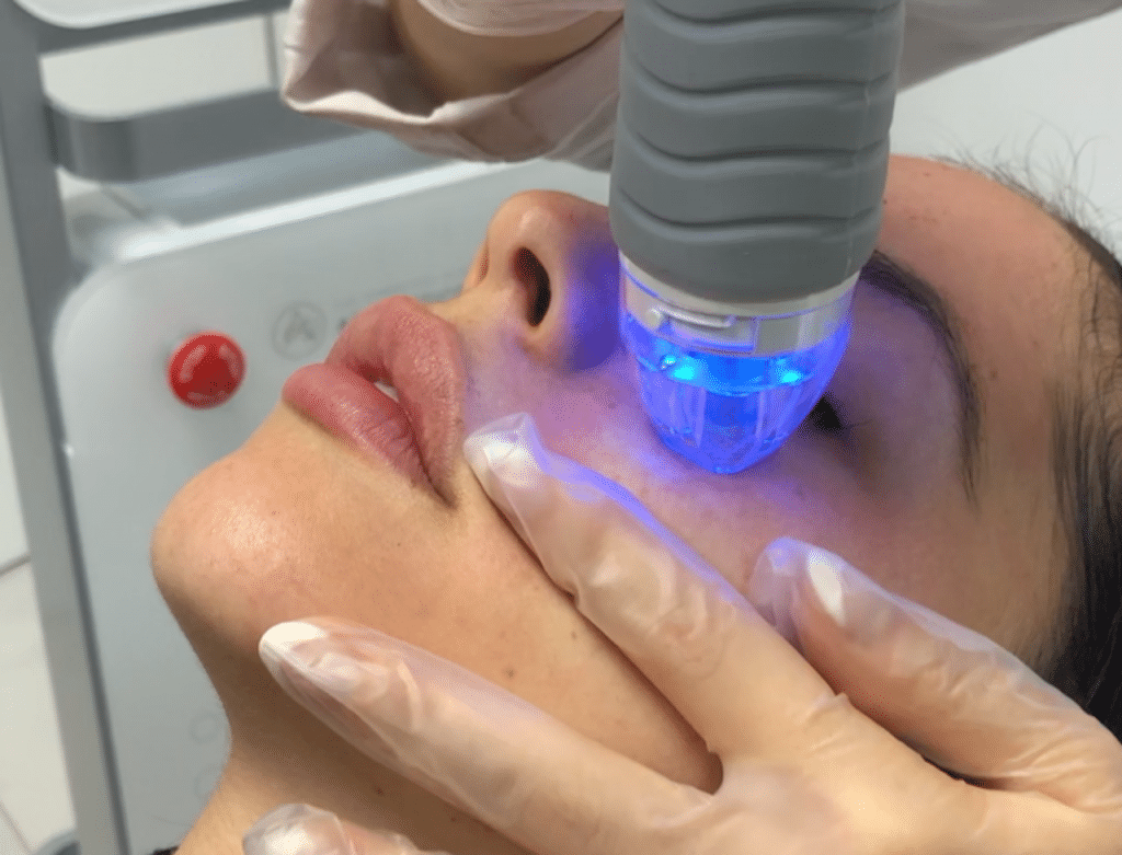How Safe Is Modern RF Micro Needling Today?