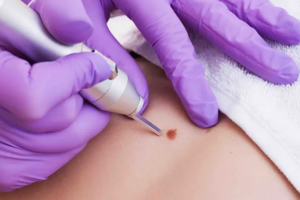 How Safe Is Modern Warts Removal Treatment?