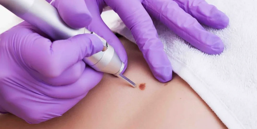 How Safe Is Modern Warts Removal Treatment?