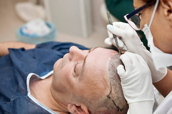How Soon Can You See FUE Hair Transplant Results