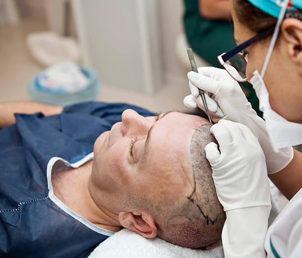 How Soon Can You See FUE Hair Transplant Results