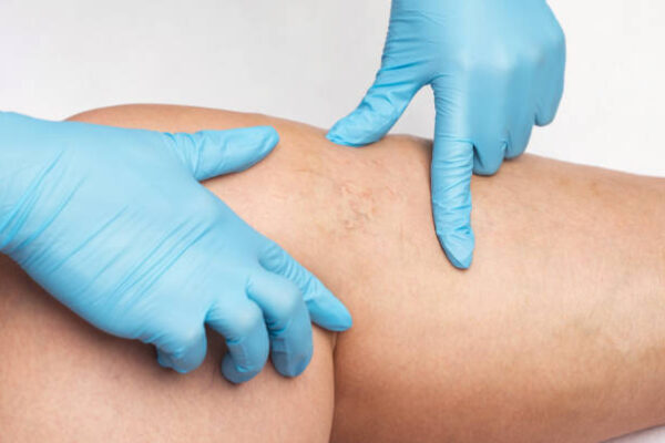 How Soon Can You See Spider Vein Treatment Results