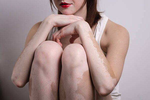 How do specialists handle stubborn vitiligo treatment
