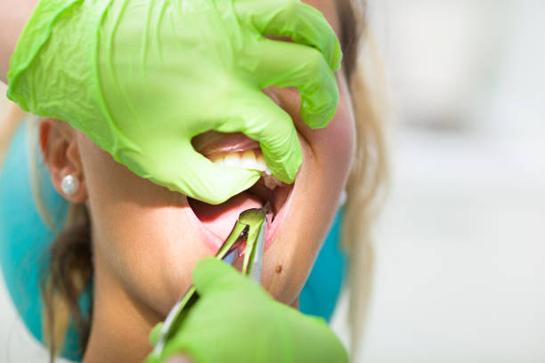 How to Choose the Right Dentist for Tooth Removal
