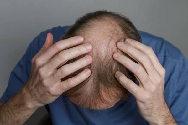 Is Hair Loss Treatment Recommended for All Ages