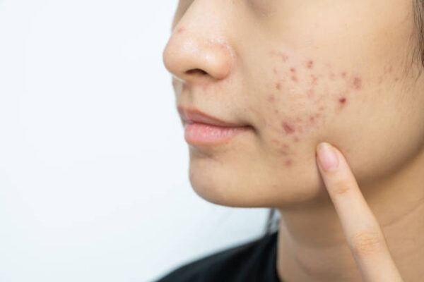 Is Laser Acne Scar Treatment Safe for Darker Skin