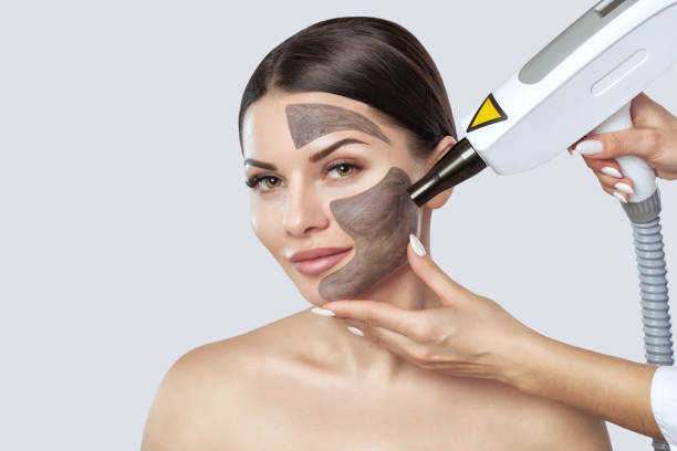 Is Laser Carbon Peel good for oily skin types