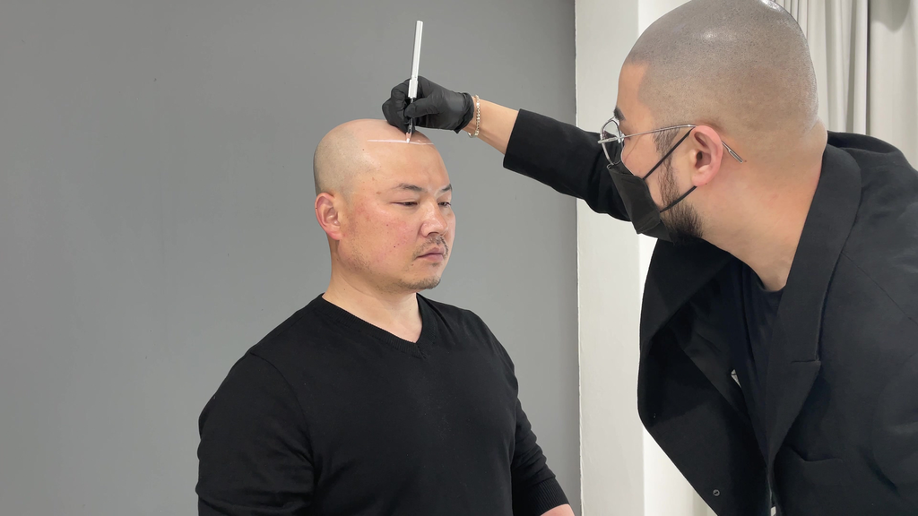 Scalp Micropigmentation in Abu Dhabi