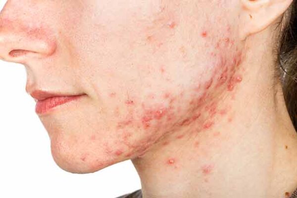 Acne Treatment in Abu Dhabi