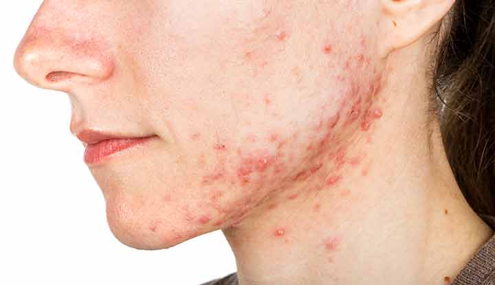 Acne Treatment in Abu Dhabi