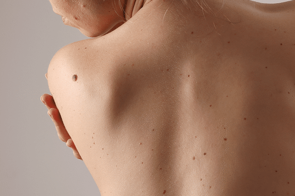 Skin Tag Removal in Abu Dhabi