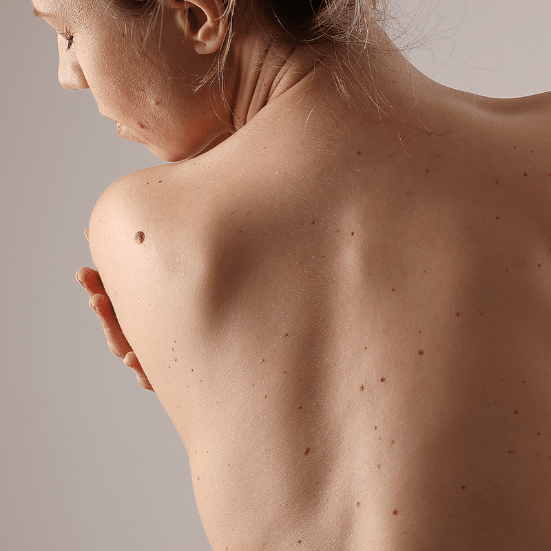 Skin Tag Removal in Abu Dhabi