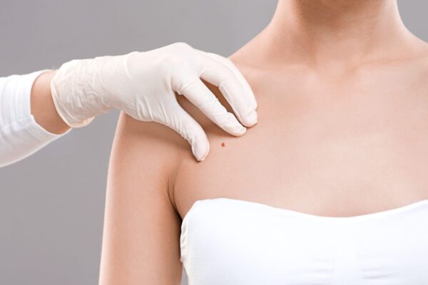 What Results Can Mole Removal Deliver?