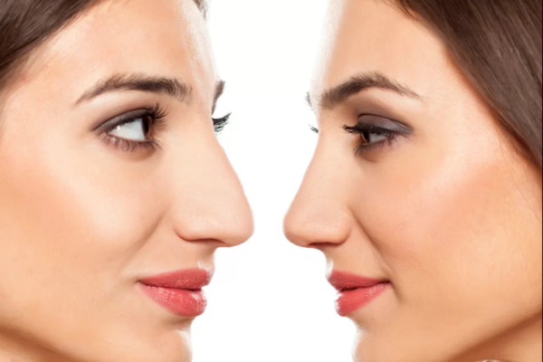Rhinoplasty In Dubai
