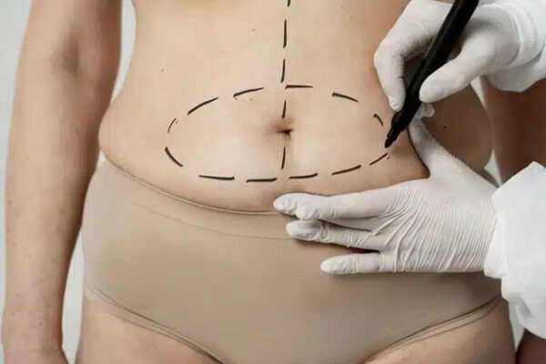 Tummy Tuck in Dubai