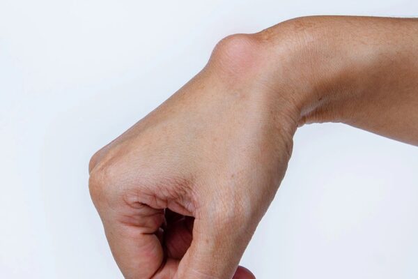 علاج الورم الشحمي في أبو ظبي