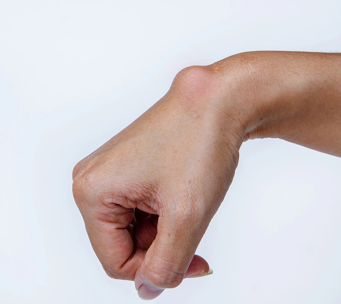 علاج الورم الشحمي في أبو ظبي