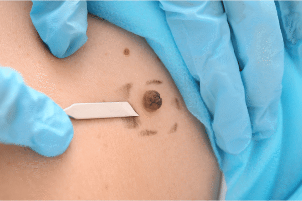 علاج إزالة الثآليل في أبوظبي