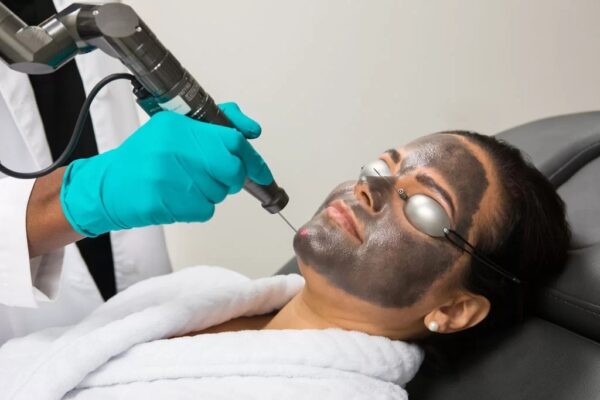 تقشير الكربون بالليزر في ابوظبي