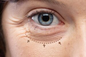Eyelid Bag Surgery Dubai