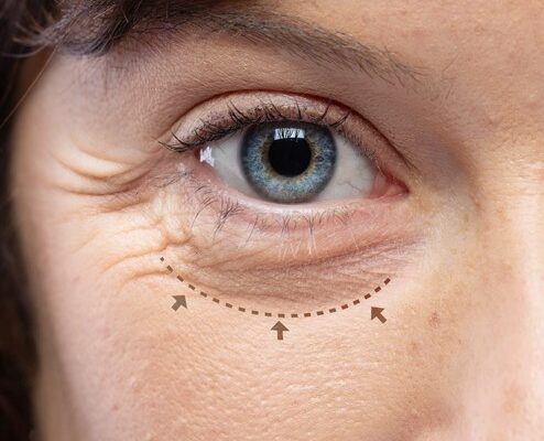 Eyelid Bag Surgery Dubai