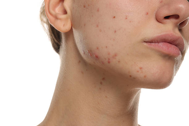 Can Laser Acne Scar Treatment Fade Old Acne Marks