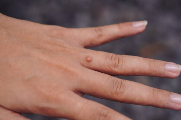 Can Wart Removal Remove Warts Permanently