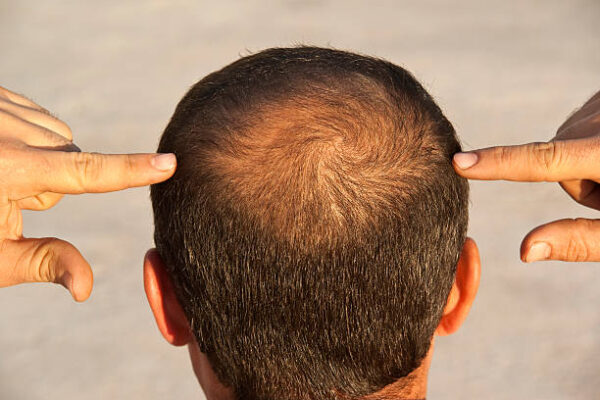 Does Hair Loss Treatment Support Natural Hair Thickness