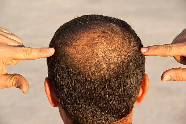 Does Hair Loss Treatment Support Natural Hair Thickness