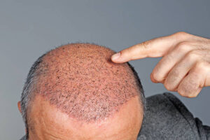 Does Hair Transplant Work Better On A Receding Hairline