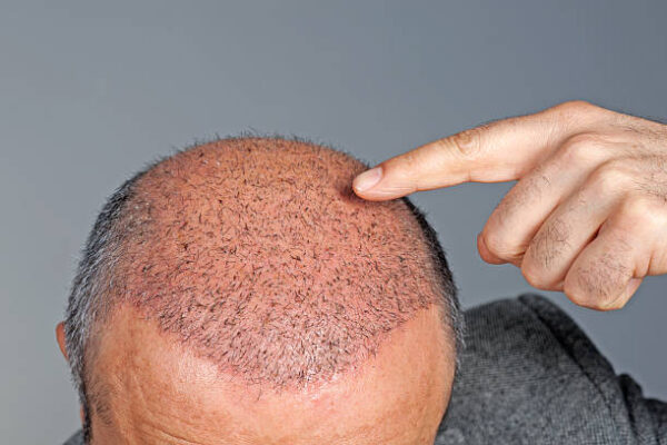 Does Hair Transplant Work Better On A Receding Hairline