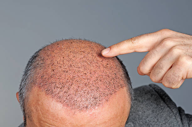 Does Hair Transplant Work Better On A Receding Hairline