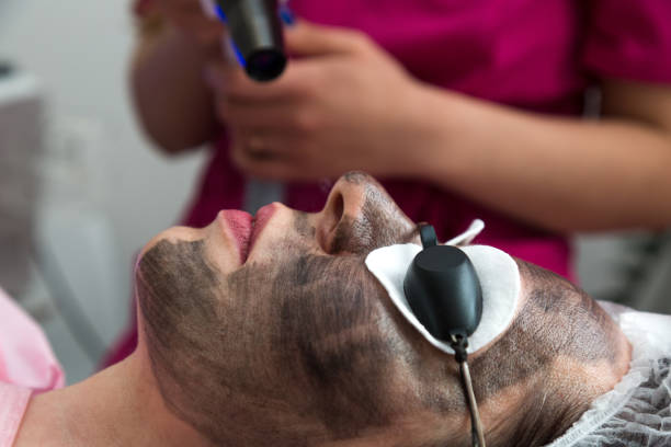 Does Laser Carbon Peel Support Healthy and Clear Facial Skin