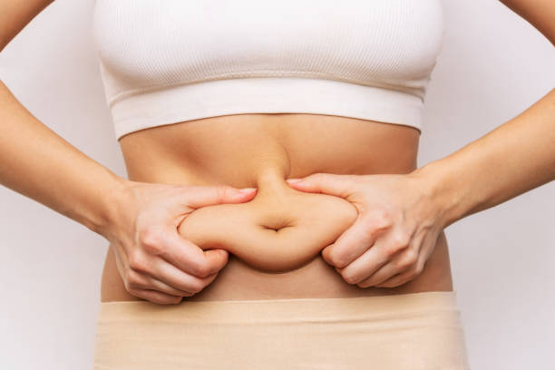 Does Mini Abdominoplasty Change Belly Button Appearance